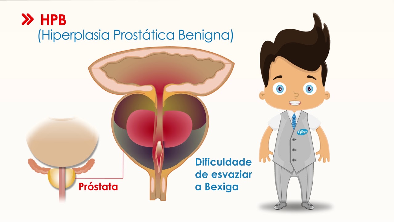 hiperplasia-prostatica-benigna